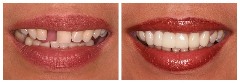 dental implant restoration
