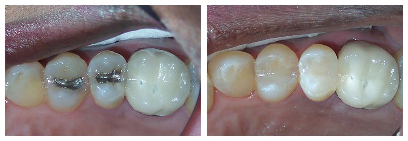 composite dental fillings